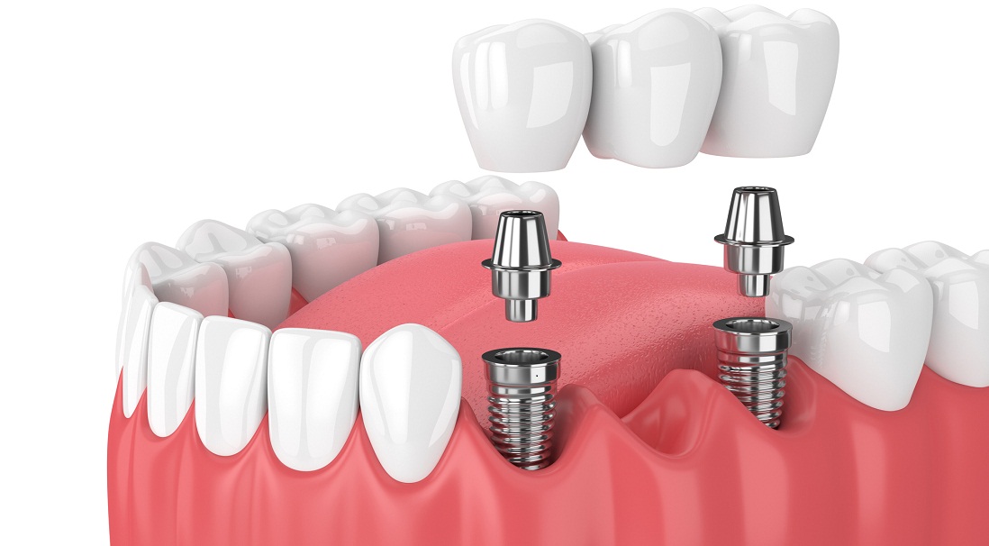 Implanty zębowe są polecane w przypadku braku pojedynczego zęba, braku kilku zębów obok siebie, w różnych miejscach jamy ustnej lub przestrzeni międzyzębowej.